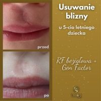 kliniki usuwaj  pieprzyki warszawa LaserQ Clinic - usuwanie znamion, blizn, depilacja laserowa Warszawa Wilanów